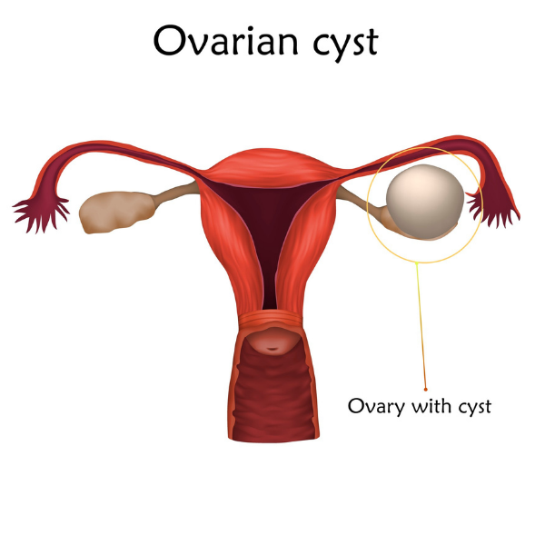 Ovarian cyst removal surgery in Buffalo NY